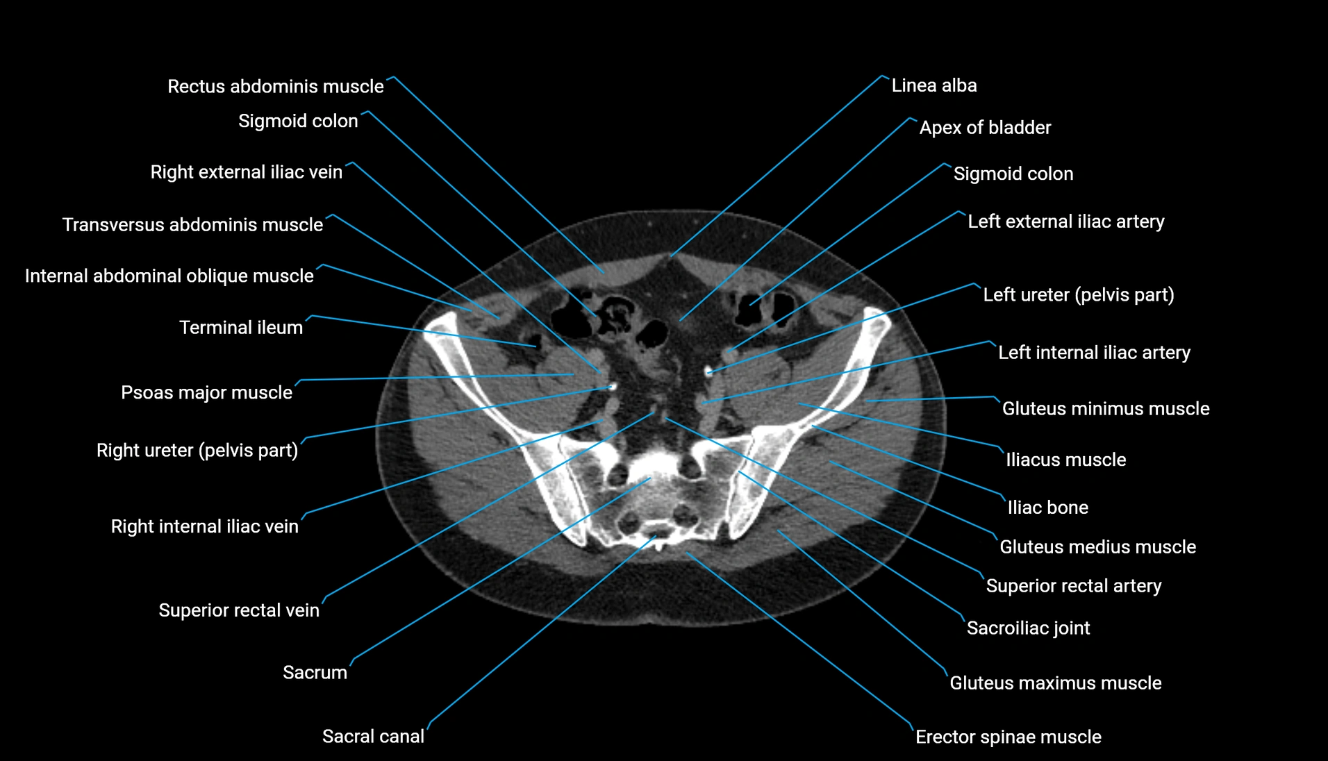 CT urogram axial cross sectional anatomy  labelled radiology image-00192.webp